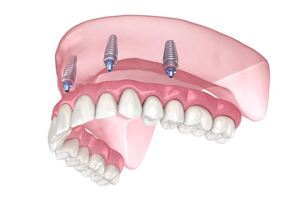 Prótesis de implante: sonrisa segura y estable